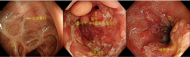 장이 예민해서? 원인 모를 설사, 한 달 넘었다면 ‘이 병’ 의심[건강 팁]