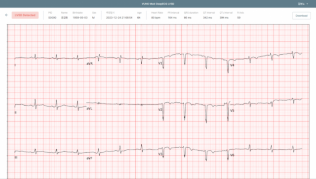 뷰노의 AI 기반 심부전 선별 소프트웨어 '뷰노메드 딥ECG LVSD'의 운영 화면. 사진제공=뷰노