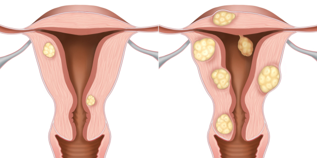 초기 자궁근종(왼쪽)과 진행된 자궁근종의 모식도. 사진 제공=서울아산병원