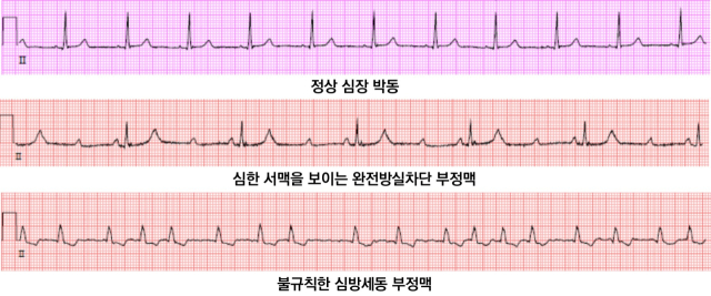 정상 심장 박동(위쪽부터)과 심한 서맥을 보이는 완전방실차단 부정맥, 불규칙한 심방세동의 심전도 그래프. 사진 제공=서울아산병원