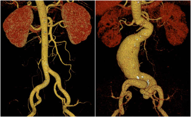 정상 복부 대동맥(왼쪽)과 복부 대동맥류(오른쪽)의 복부 컴퓨터단층촬영(CT) 검사 사진. 사진 제공=서울아산병원