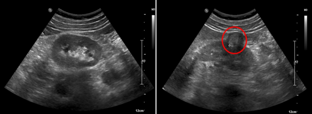 정상 신장(왼쪽)과 신장암 환자의 초음파 검사 사진. 오른쪽 사진에서 주변 신장 실질보다 어둡게 보이는 부분(빨간색 동그라미)이 신장암이다. 사진 제공=서울아산병원