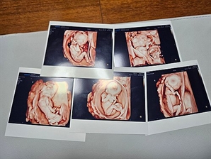 "아기집 5개 보고 2주간 매일 울었어요"…'다섯쌍둥이' 낳기로 결심한 이유