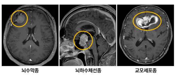 “머리 아프고 속까지 울렁” 혹시 뇌종양일까 [건강 팁]