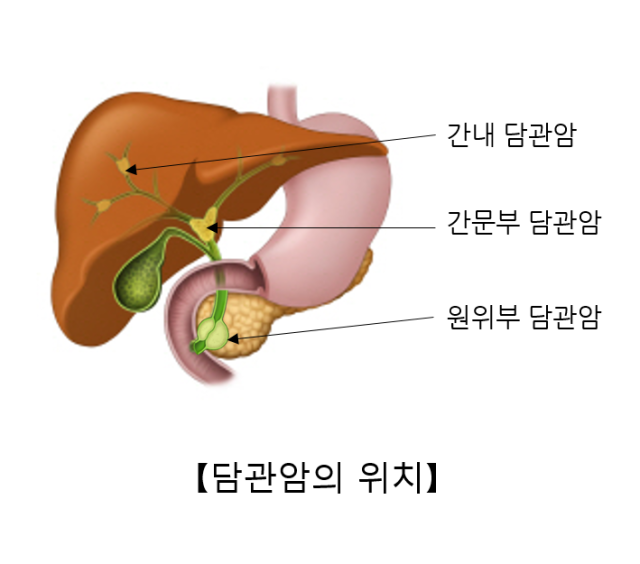 얼굴 노래지고 속이 더부룩…혹시 ‘이 암’일까 [건강 팁]