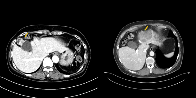컴퓨터단층촬영(CT) 검사 결과 담낭체부에 발생한 담낭암(왼쪽, 노란색 화살표)과 좌간에 발생한 간내 담관암(노란색 화살표)이 각각 관찰된다. 사진 제공=서울아산병원