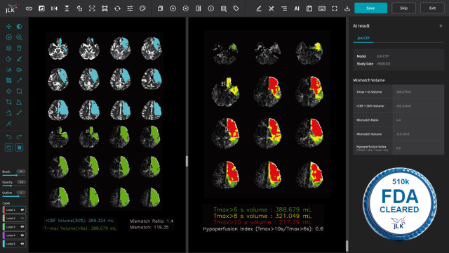 제이엘케이 뇌 CT 관류영상 분석 AI 솔루션 JLK-CTP. 사진 제공=제이엘케이