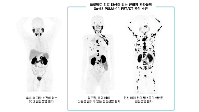 ‘플루빅토’ 치료 대상이 되는 환자의 전립선암 맞춤 PET/CT영상 소견. 사진 제공=서울아산병원