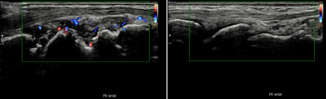 류마티스관절염 환자(왼쪽)와 건강한 일반인의 오른쪽 손목 초음파 사진. 사진 제공=서울아산병원