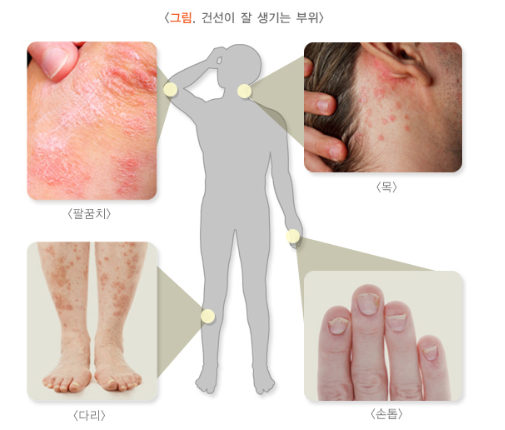 “그분 오셨다” 환절기 참을 수 없는 가려움…건선 관리, 이렇게[헬시타임]