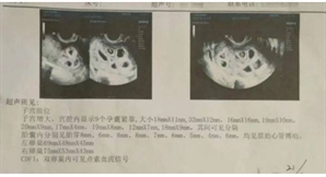 불임 걱정했는데, 9쌍둥이라고?…25세 여성 ‘이것’ 맞고 바로 임신