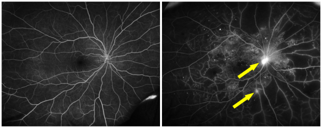 광각형광안저혈관조영술 검사 결과 당뇨망막병증 환자(오른쪽)에서 정상과 달리 망막신생혈관(노란색 화살표)을 확인할 수 있다 사진 제공=서울아산병원