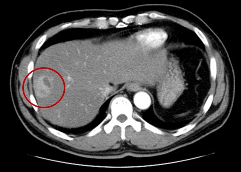 I heard that liver cancer is scary… Don’t worry less if you get this test twice a year [건강 팁]