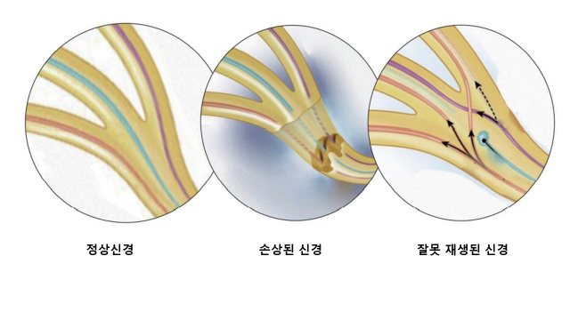 정상 신경과 손상된 신경, 잘못 재생된 신경의 예시. 사진 제공=한림대 동탄성심병원