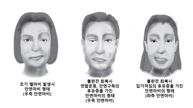 안면신경마비의 후유증. 사진 제공=한림대 동탄성심병원