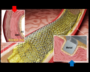 심혈관 스텐트 시술 부작용, 레이저로 해결한다