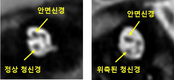 노인 2명 중 1명이 겪는 ‘이 증상’ 치매 위험도 높인다는데 [건강 팁]