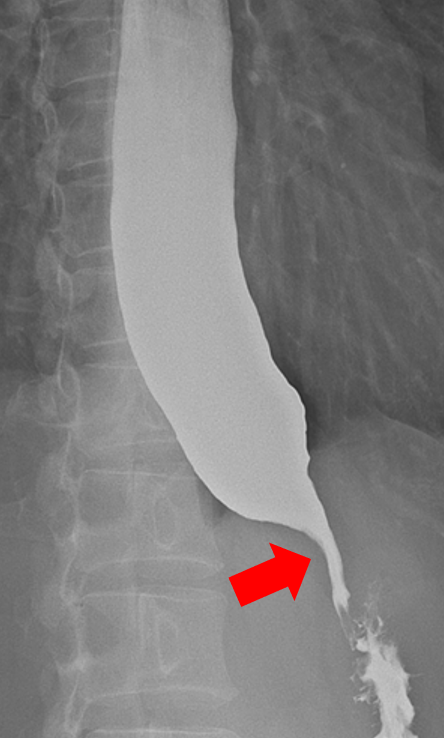 식도 조영술 검사 결과 식도 체부가 늘어나면서 조영제가 잘 배출되지 않고 하부 식도조임근이 마치 새부리 모양(빨간색 화살표)으로 관찰되는 것을 확인할 수 있다. 사진 제공=서울아산병원