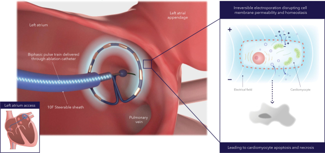 심장의 각 조직은 서로 다른 전기장 강도를 갖는다. 펄스장 절제술(PFA·Pulse Field Ablation)은 교대로 양극과 음극 전극을 사용하면 카테터 주변에 양극성 전기장이 형성되어 조직으로 확장되는 원리를 이용해 심방세동을 치료하는 최신 중재시술이다. 전기장이 세포막 투과성을 증가시키면 세포기능장애를 유발하고 그 결과 타깃하는 심근세포만 사멸시킬 수 있다. 자료·사진 제공=미국심장학회 공식 학술지 'Circulation' 2023년 5월호 발표 논문