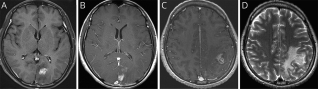 극심한 두통을 호소하며 내원한 40대 여성 환자의 초기 뇌 MRI(A)에서 왼쪽 후두엽에 조영증강된 종괴가 관찰됐으나 3개월 뒤 시행한 뇌 MRI(B) 에서 사라졌다. 8개월 뒤 시행한 뇌 MRI(C)에서 왼쪽 두정엽에 새롭게 조영증강된 종괴가 발견됐고 종괴 주변(D)에 심한 뇌부종이 동반된 모습이 확인됐다. 사진 제공=서울대병원