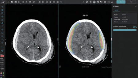 제이엘케이의 두개내출혈 검출 인공지능(AI) 솔루션 ‘JLK-ICH’ 구동 화면. 사진 제공=제이엘케이
