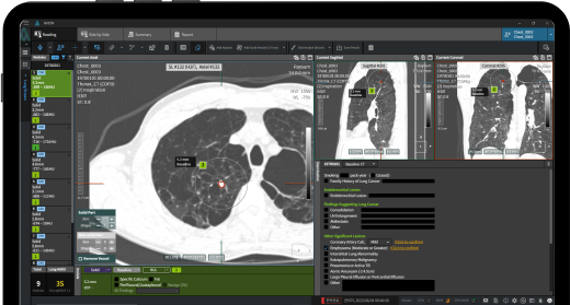 폐결절 검출 및 분석 장면. 사진=코어라인소프트 홈페이지