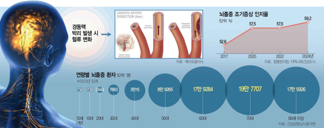 “3대 몇 치세요?” 욕심 내다간…'젊은 뇌졸중' 찾아온다 [메디컬 인사이드]