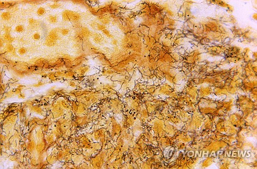 미국 질병통제예방센터(CDC)가 공개한 매독에 감염된 인체 조직의 현미경 사진. AP연합뉴스