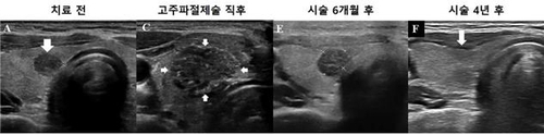 고주파절제술을 이용한 미세갑상선유두암 치료 과정. 시술 직후 괴사된 종양과 주변부가 넓게 보이지만 시간이 지나면 완전히 소멸된 것을 볼 수 있다. 사진 제공=서울대병원