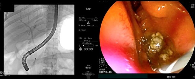 내시경적 역행성 담췌관조영술(ERCP) 시술로 담관결석을 빼내는 모습. 한림대 동탄성심병원 제공