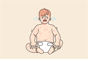 국내 홍역환자 6년 만에 최다…동남아 국가에서 유행