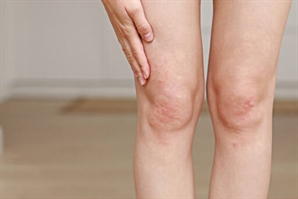 "놀이공원서 신나게 놀았는데 온 다리에 붉은 반점이"…여름철 '이 질병' 주의보, 뭐길래?