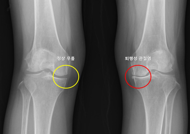 정상 무릎(노란색)과 퇴행성 관절염 무릎(빨간색)의 X-ray 영상. 사진 제공=서울대병원