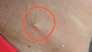 "생선가시 삼켰는데 목을 뚫고 나왔다"…절대 해선 안 되는 행동은?