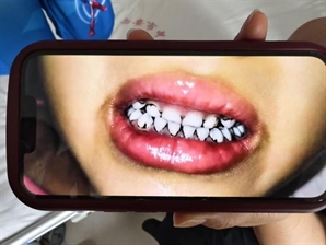 "6살 딸, 흰머리 나고 치아 까매져"…유치원생 20명에 무슨 일이