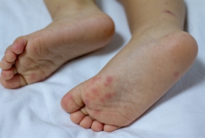 어린이집 다녀오더니 열 펄펄 나는 아이…"해열제도 소용없어" 비상 걸린 '이 병'