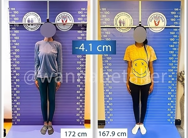24일(현지시간) 데일리메일에 따르면 최근 튀르키예에서는 이른바 ‘키 축소 수술’이 새로운 의료 관광 상품으로 자리 잡고 있다. 사진은 튀르키예 이스탄불의 ‘하이트 리덕션’에서 키 축소술을 받고 키를 4.1㎝ 줄인 여성 환자. 사진 제공=하이트 리덕션
