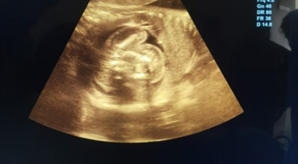 생후 20일 아기인데 왜 이렇게 배가 볼록?…"뱃속에 '쌍둥이 태아' 있었다"