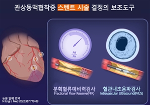 “시술 줄일까, 재발 막을까”…심장혈관 검사법 따라 치료 달라진다