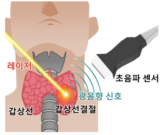 빛과 초음파를 활용한 갑상선암 판결 기술. 사진 제공=포스텍