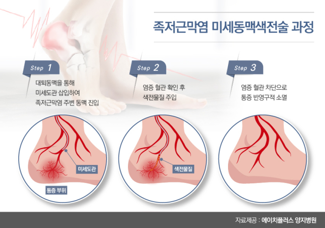 족저근막염에 대한 미세동맥색전술 과정. 사진 제공=에이치플러스양지병원