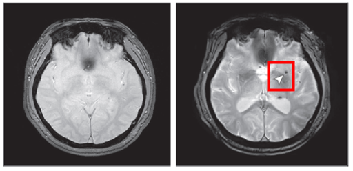 8년 후 뇌 미세출혈이 발생한 뇌영상 이미지. 질병관리청