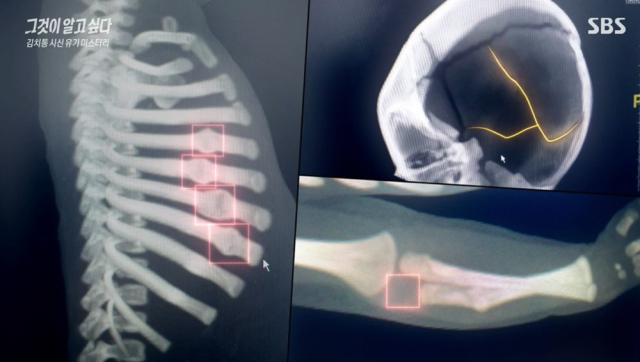숨진 15개월 딸 '김치통' 속에 넣어둔 채…부모는 보육수당을 챙겼다 [오늘의 그날]